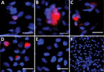 Immunofluorescent images from Vero E6 cells exposed to semen samples obtained at day 7 after symptom onset from volunteers from Réunion Island with dengue virus (DENV) infection in a study of virus clearance and effects on reproductive function. A) Seminal plasma (patient 6); B) whole semen cells (patient 3); C) cells from 40% fraction obtained after semen preparation (patient 6); D) DENV-1 infected Vero E6 cells (positive control) (multiplicity of infection 0.01 for 3 days); E) noninfected Vero E6 cells; F) Vero E6 cells inoculated with noninfected semen (negative controls). VeroE6 cells were inoculated with the semen fractions indicated from DENV-infected (A, B, C) or uninfected patients (E) and cultured for 7 days (first passage). Images were made after detection of DENV envelop protein (DENV-E) from a second passage on VeroE6 of culture supernatants collected after the first passage. Red indicates DENV-E, blue indicates DAPI staining. Scale bars indicate 20 μm. 