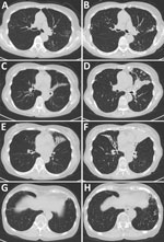 Comparison of chest computed tomography findings over time for patient who had  chronic pulmonary disease caused by Tsukamurella toyonakaense. Findings are shown from before Tsukamurella species was detected (A, C, E, and G) and 6 years later (B, D, F, and H). A and B show that nodules in right segment 2 and left segment 6 were unchanged. C and D show that bronchiectasis in lingula had progressed. E and F show that bronchiectasis newly appeared in the middle lobe. G and H show that nodules newly appeared in left segments 8–10.