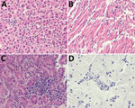 Microscopic lesions caused by Bagaza virus infection in liver, heart, kidney, and brain tissue of red-legged partridges (Alectoris rufa), Portugal, 2021. A) In liver, congestion, hemozoin presence in Kupffer cells, focal hepatocyte necrosis, and a moderate mononuclear infiltrate are visible despite some freezing artifacts. B) In heart, congestion, hemorrhage, edema, degeneration of myofibers of the myocardium, and endothelial swelling and moderate to abundant diffuse mononuclear infiltrates are visible. C) In kidney, tubulointerstitial nephritis characterized by congestion, hemorrhage necrosis of proximal convoluted tubular epithelium, and diffuse moderate to abundant mononuclear inflammatory infiltrate are visible. D) In brain, mild nonpurulent encephalitis with congestion, mononuclear cell extravasation, and endothelial cell swelling are visible. Hematoxilin eosin staining; original magnification ×400.