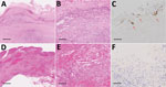 Comparison of images from patients in the Helicobacter cinaedi group with patients from the non–H. cinaedi group among 10 patients with infected aortic aneurysms with or without H. cinaedi, Aichi, Japan, September 2017–January 2021. Immunohistochemistry was performed on the whole cell lysates of H. cinaedi strain MRY08-1234 isolated from immunocompromised patients in Japan by raising anti–rabbit H. cinaedi IgG. One of 2 case-patients with resected tissue in the H. cinaedi group had positive immunostaining (patient 1). A–C) Case-patient 1 in the H. cinaedi group. D–F) Case-patient 4 in the non–H. cinaedi group. In images from both patients, lymphocyte and neutrophil infiltrates, cholesterol clefts, foam cells, plasma cells, foreign body giant cells, and hemosiderin deposition are visible (A, B, D, E; hematoxylin & eosin). Immunohistochemistry stain shows of H. cinaedi organisms in the aortic intima (arrow in C) and negative results (F). Scale bars: 1,000 µm in A, D; 100 µm in B, E; 50 µm in C, F.