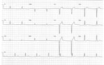 Electrocardiogram of a 23-year-old patient in Israel with Q fever, showing a left bundle branch block with sinus bradycardia of 35 bpm.