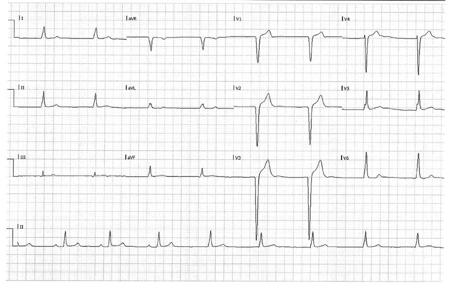 Figure 2 - Acute Q Fever with Atrioventricular Block, Israel - Volume ...