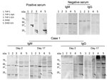 Western blots using serum samples from a febrile patient (case 1) in Wakayama Prefecture in study showing serologic evidence of human exposure to ehrlichiosis agents in Japan. Serum samples were collected from the patient on day 2 and 17 after onset of illness. Human THP-1 and canine DH82 cells were uninfected or infected with Ehrlichia chaffeensis . THP-1 cells were also infected with Anaplasma phagocytophilum. Cell lysates were separated and Western blot was performed as described (Appendix). We used uninfected THP-1 and DH82 cells as negative lysate controls. We used rabbit serum against recombinant P44 antigens specific for A. phagocytophilum and recombinant P28 antigens specific for E. chaffeensis (1:10,000 dilution) as positive serum controls. We used serum from a healthy donor as a negative control serum (Precision for Medicine, https://www.precisionbiospecimens.com). The patient’s serum samples and negative control serum were diluted 1:250 and used to probe the blots. We used alkaline-phosphatase-conjugated goat anti-human IgM μ-chain and anti-human IgG γ-chain (Thermo Fisher Scientific, https://www.thermofisher.com) as secondary antibodies. Arrows indicate E. chaffeensis-specific P28 antigens (encoded by a p28 multigene family). Arrowhead shows A. phagocytophilum-specific P44 antigen (encoded by a p44 multigene family).