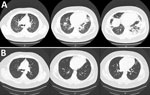 Chest computed tomography (CT) images of a male patient in Japan who was hospitalized with multisystem inflammatory syndrome. A) CT performed at hospital admission revealed infiltration in bilateral lower lobes. B) Chest CT performed 1 month after discharge revealed that most of these lesions had resolved.