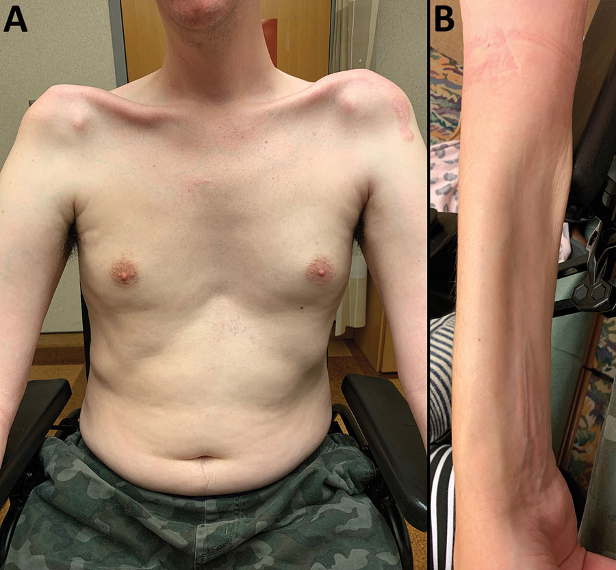 Physical manifestations of a patient who had imported Haycocknema perplexum infection, United States. Images show profound atrophy of the pectoralis and deltoid (A) and the forearm flexor musculature (B).