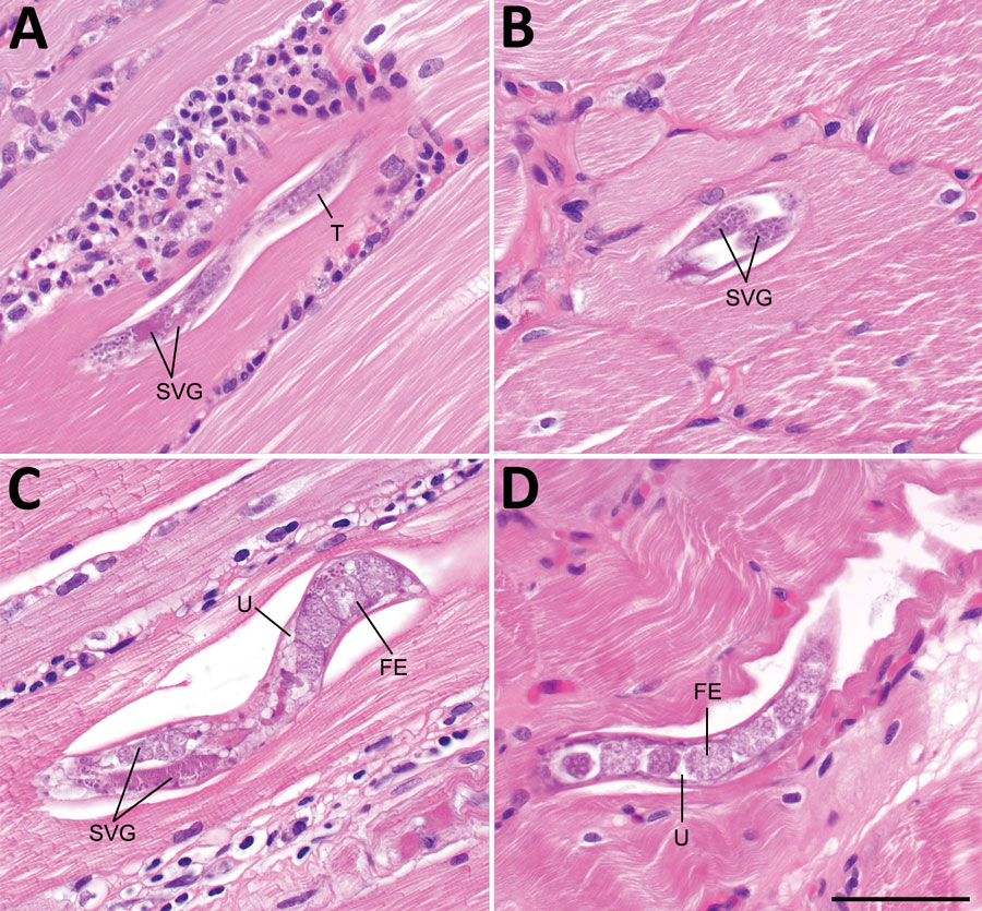 Histologic section of muscle tissue from the left deltoid of a patient who had imported Haycocknema perplexum infection, United States. A) Male H. perplexum in longitudinal section; B) anterior region of female H. perplexum in transverse section; C) anterior and midbody regions of gravid female; D) posterior region of gravid female. Scattered necrotic and regenerating fibers and dense inflammatory exudates were also observed. FE, fertilized eggs; SVG, subventral glands; T, testis; U, uterus. Scale bar indicates 50 μm.