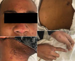 Cutaneous manifestations of imported monkeypox from international traveler, Maryland, USA, 2021. Numerous pustules on erythematous base with some central umbilication and acrofacial propensity are shown. 