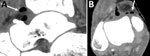 Sagittal (left) and axial (right) contrast-enhanced computed tomography images demonstrating ankle joint effusion associated with gas (arrows) in an immunocompromised man in France who had septic arthritis and soft tissue infection caused by Nannizziopsis obscura.