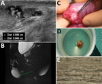 Diagnostic evaluation of Dirofilaria repens testicular infection in a child from Italy, a boy 13 years of age who had a 5-month history of swelling in the left testicle. A) Ultrasound scan showed a 0.5 × 0.9 cm hypoechoic cyst with moving artifacts and thread-like hyperechoic structures. B) Magnetic resonance imaging showed the cyst was located on the testis without signs of infiltration and contained fluid mixed with tubular structures and moving artifacts. C) Exploration of the scrotum before cyst excision showed a well-circumscribed, encapsulated tense nodule on the left side. D) The cyst was excised and a coiled roundworm was found in the opened capsule. E) We identified the nematode as a female D. repens nematode by microscopically observing typical longitudinal ridges on the body surface. Scale bar indicates 50 μm. Dist, distance.