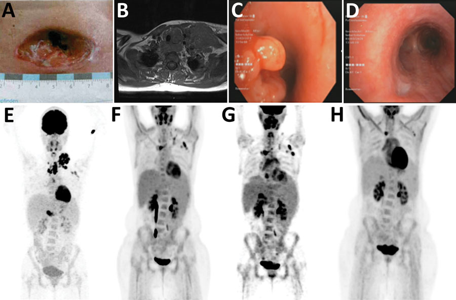 Clinical manifestations and radiologic findings in the course of disease in a 23-year-old woman with disseminated M. genavense infection preceding Hodgkin lymphoma, Germany. A) Cervical wound after initial lymph node extirpation. B) Magnetic resonance imaging at the time of initial evaluation. C) Endobronchial view of tracheo-esophageal fistula before positioning of a stent. D) Endobronchial view of the prior tracheo-esophageal fistula after treatment. Whitish scar tissue is seen at the bottom left. E) 18F-FDG-PET scan at initial evaluation (maximum intensity projection). Cervical lymph node mass is seen, with no pathologic uptake in the abdomen. F) 18F-FDG-PET scan after 6 months of antibiotic treatment showing reduced uptake. G) 18F-FDG-PET scan shortly before Hodgkin lymphoma was diagnosed showing new hepatosplenomegaly and lymphadenopathy. H) 18F-FDG-PET scan after antibiotic and chemotherapy without pathologic enhancement.