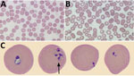 Babesia microti detected on Wright-stained peripheral blood smears from a 58-year-old man, southwest Nova Scotia, Canada, July 2021. Some typical features of B. microti infection include multiple ring forms present in erythrocytes (A), extracellular ring forms (B), and ring forms of various shapes and sizes (C), including the pathognomonic finding of merozoites arranged in a tetrad formation resembling a Maltese cross (arrow). Images in panels A and B obtained by using Wright’s stain (original magnification ×100), For panel C, the CellaVision DM96 system (https://www.cellavision.com) and the Cellavision Remote Review Software version 6.0.1 build 7 were used to capture and display cells with abnormalities.