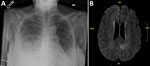 Imaging studies from a 65-year-old woman with multiple myeloma undergoing chimeric antigen receptor T-cell therapy who was admitted to the hospital for worsening foot and ankle pain, California, USA. A) Chest radiograph image, showing a moderate right-sided pleural effusion and adjacent pulmonary opacities indicative of pneumonia. B) Magnetic resonance imaging of the patient’s brain, showing the infarct involving the left medial parietal lobe.
