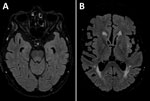 Axial FLAIR magnetic resonance imaging brain sequence in a patient with locally acquired Japanese encephalitis virus detected using clinical metagenomics, New South Wales, Australia. A) Equivocal hyperintensity in the dorsal midbrain and pons; B) sparing of the thalamus and basal ganglia.