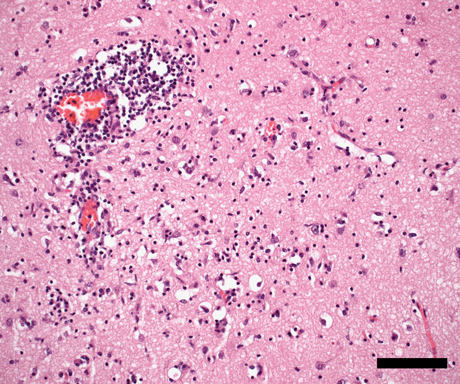 Temporal neocortex showing encephalitis with perivascular and interstitial lymphocytes, macrophages/activated microglia, and neuronophagia in patient with locally acquired Japanese encephalitis virus detected using clinical metagenomics, New South Wales, Australia. Hematoxylin and eosin stain; scale bar indicates 100 µm.