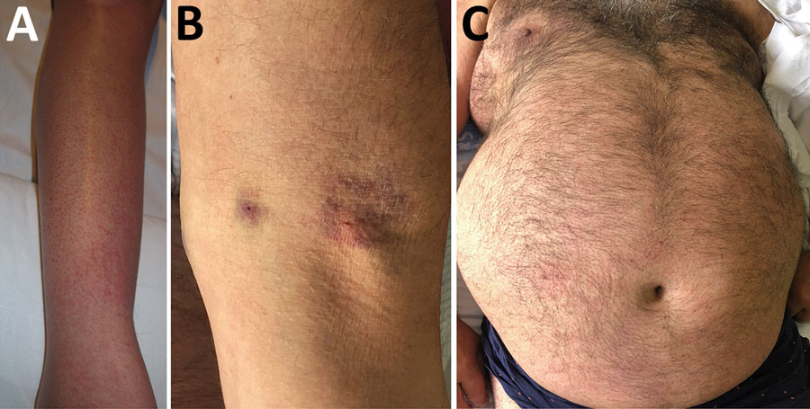 Images of patients in study of Crimean-Congo hemorrhagic fever, Spain, 2013–2021. A) Details of a slightly purpuric rash on the leg of patient 8. B) Ecchymosis on the arm of patient 5. C) Mild rash on the chest of patient 9. 