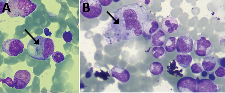 Bone marrow biopsy findings from patient 5 (A) and patient 9 (B) in study of Crimean-Congo hemorrhagic fever, Spain, 2013–2021. Arrows indicate macrophages with hemophagocytosis phenomena of red blood cells and platelets.