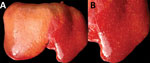 Diaphragmatic view of diseased liver from an aborted ovine fetus (fetus B) with possible Francisellaceae infection, Uruguay. A) Myriad discrete, white to yellowish, round, coalescing foci are visible, ranging from pinpoint to ≈2 mm in diameter, with a multifocal disseminated distribution in the hepatic parenchyma indicative of necrotizing hepatitis. Lesions are more visible in the left liver lobe (right side of the image) than the right liver lobe (left side of the image), in which the hepatic parenchyma is diffusely pale due to moderate autolysis. B) Isolated view of left liver lobe with disseminated foci of necrotizing hepatitis, which are characteristic in cases of tularemia. 