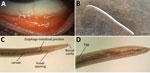 Imaging results for Thelazia callipaeda eyeworm infection in a woman in Hungary. A) Follicles in the inferior tarsal conjunctiva in the patient’s left eye 5 days after removal of an adult female T. callipaeda worm. B) Female worm removed from the patient’s left eye. Scale bar indicates 1 mm. C, D) Morphologic characteristics of the T. callipaeda worm from the patient (C) and eggs visible within the specimen (D). Original magnification ×100. 