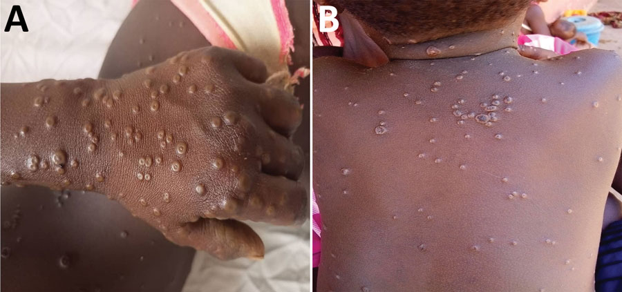 Examples of rash severity detected during national monkeypox surveillance, Central African Republic, 2001–2021. A) Serious rash on a patient’s left hand. Serious rash was reported in 5.7% of cases. B) Moderate rash on a patient’s back. Moderate rash was reported in 57.1% of cases. 