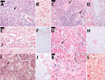 Histopathological findings in 2 case-patients with fatal reaction to 17DD yellow fever (YF) vaccine, São Paolo state, Brazil, 2017–2018. A, B) Liver tissue from case 1: A) steatotic hepatitis (arrow) with scarce inflammatory reaction and rare apoptotic bodies; B) immunostaining for YF antigens in Kuppfer cells and inflammatory cells in the portal tract. C, D) Spleen tissue from case 1: C) lymphoid hypoplasia (arrows); D) YF antigens in cells located on the white pulp and red pulp. E, F) Meningeal tissue from case 1: E) mononuclear meningoencephalitis (arrow); F) YF antigens detected in the cytoplasm of meningeal inflammatory cells. G, H) Cardiac tissue from case 1: G) mononuclear interstitial myocarditis (arrow); H) positive YF antigens detected in the inflammatory cells; I, J) Kidney tissue from case 1: I) acute tubular necrosis and interstitial nephritis (arrow); J) detectable YF antigens in the inflammatory cells. K ,L) Liver tissue from case 2: K) steatotic hepatitis with rare apoptotic bodies (inset); L) scarce immunodetection of YF antigens in the Kuppfer cells. Panels A, C, D, E, G, I, and K are hematoxylin and eosin stained; B, D, F, H, J, and L are immunohistochemistry with alkaline phosphatase conjugated polymer, using a mouse polyclonal YF antibody directed to wild strain (Instituto Adolfo Lutz, São Paolo, Brazil). Scale bars in panels A, C, E, and G indicate 50 µm and in panel K indicates 20 µm.  Original magnification ×400.