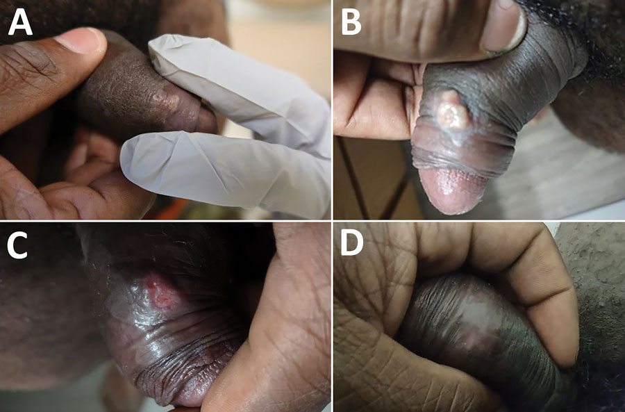 Evolution of penile lesions in patient who had monkeypox and was immunized with ACAM2000 smallpox vaccine during 2022 monkeypox outbreak, United States. A) Two days after constitutional symptoms developed; B) evolution of rash showing coalescence and development of a pustular appearance 6 days after onset of constitutional symptoms; C) ulceration of lesion on day 16; D) dissipation of lesion without residual scarring.