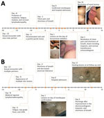 Timeline of events for 2 immunocompetent patients with monkeypox complicated by myocarditis, United States. A) A healthy 32-year-old man (patient 1) had chest pain and shortness of breath 7 days after a prodrome of headache, fatigue, malaise, and cervical lymphadenopathy and 2 days after the rash. Symptoms resolved after 10 days of illness onset and 1 day after initiation of tecovirimat. The patient received supportive care only for myocarditis. B) A healthy 37-year-old man (patient 2) had shortness of breath and decreased exercise tolerance 6 days after illness onset with bilateral inguinal lymphadenopathy and 4 days after the rash. Shortness of breath improved after 12 days of illness onset, and exercise tolerance normalized after 20 days. The patient received supportive care only for both monkeypox and myocarditis.