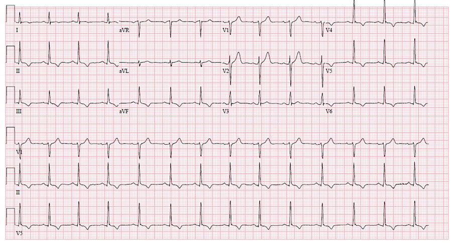 An electrocardiogram of a healthy 37-year-old man (patient 2) with monkeypox, shortness of breath, and decreased exercise tolerance shows normal sinus rhythm with T wave inversions in the inferior and anterolateral leads.