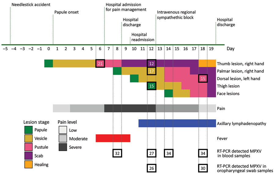 Timeline of symptoms and testing in a case of MPXV transmission to healthcare worker through needlestick injury, Brazil. All collected specimens had RT-PCR detectable MPXV through hospital discharge. Numerals inside squares indicate RT-PCR cycle threshold values. MPXV, monkeypox virus; RT-PCR, reverse transcription PCR.