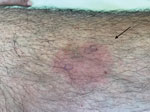 Recurrent skin manifestations revealing Helicobacter cinaedi bacteremia in a man on ibrutinib therapy for chronic lymphocytic leukemia, France. A bright red, slightly painful lesion with a sharp border was localized on the left thigh.