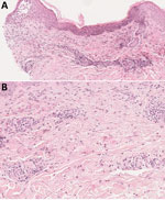Histologic aspect of a skin lesion revealing Helicobacter cinaedi bacteremia in a man on ibrutinib therapy for chronic lymphocytic leukemia, France. Skin biopsy obtained from erythema on the right side of the abdomen (original magnification ×50 in panel A, ×100 in panel B) show eosinophilic spongiosis leading to spongiotic vesicles and inflammatory perivascular and interstitial infiltrate, mostly located in the superficial and mid dermis and composed of eosinophils and lymphocytes, with no atypical cells. Hematoxylin-eosin-saffron stains.