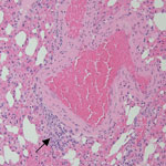 Representative tissue section from the lung of a bat in study of histopathologic changes in Mops condylurus bats naturally infected with Bombali virus, Kenya. We stained lung tissue sections from a Bombali virus–positive bat with hematoxylin and eosin. Arrow indicates focal minimal mononuclear cell infiltrate. Original magnification ×200.