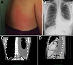 Dirofilaria repens infection with subcutaneous and pleural manifestations in a woman in Slovenia. A) Erythematous itchy skin lesion on the patient’s back measuring 15 cm x 15 cm (photograph taken by the patient). B) Frontal radiograph showing large left-sided pleural effusion. C, D) Contrast-enhanced computed tomography images showing large left-sided pleural effusion, uneven thickening of pleura, and a focal, heterogeneously enhancing soft tissue mass measuring 26 mm × 16 mm × 14 mm (arrows) in the posterior inferior part of the costal pleura in the coronal (C) and sagittal (D) plane.