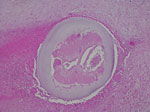 Photomicrograph of a cross-section of a Dirofilaria repens female in the background of necrosis in a sample from a woman in Slovenia. Image shows a multilayered cuticle with external ridges (feature that discriminates D. repens nematodes from other filariae infecting humans in the Mediterranean region); muscle cells, digestive tract and 2 uteri are well visible. The diameter at the widest point of the parasite is 0.6 mm. Hematoxylin and eosin stain; original magnification ×200.