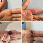Progress of monkeypox lesion on the finger of a previously healthy male physician in Portugal after occupational needlestick injury from pustule. A) Index lesion on the fourth day of illness. B) Index lesion on the sixth day of illness. C) Index lesion on the 18th day of illness. D) Necrotic scab underneath the devitalized tissue of the index lesion on the 24th day of illness.
