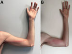 Monkeypox signs in a previously healthy male physician in Portugal after occupational needlestick injury from pustule. A) Tender, indurated, erythematous, and well-delimited linear streak from the left finger to the armpit, on the seventh day of illness. B) Aggravated lymphangitis on the ninth day of illness.