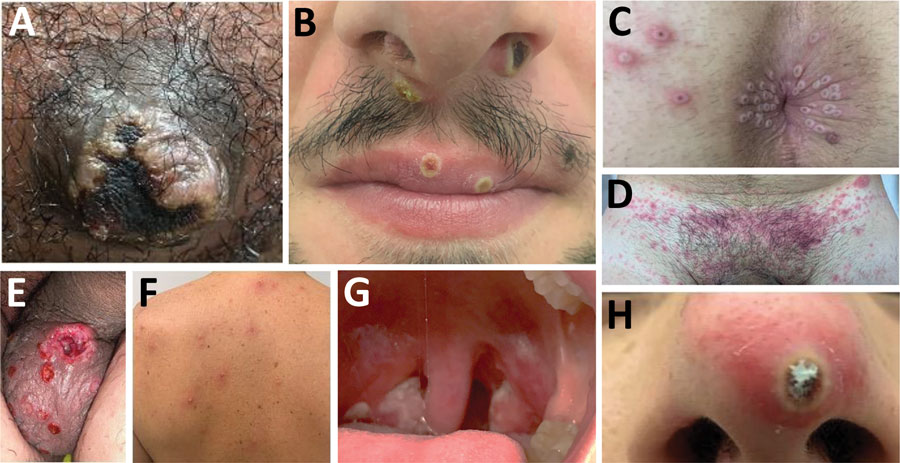 Sites of monkeypox lesions in observational cohort study of evolving epidemiologic, clinical, and virological features of monkeypox in southern France, 2022. A) Primary inoculation site showing an irregular pustule with necrotic crust of the right nipple. B) Pustular lesions with a crusted center on the mucosa of the upper lip, close to the left oral commissure and left nasal orifice. C) Pustules circumferentially distributed on the anal margin and perianal skin of varying sizes and stages of evolution; some with central necrotic crusts. D) Perineally extended purpuric lesions. E) Scrotal lesions of varying sizes and stages of evolution with edema surrounding the larger ulcero-hemorrhagic ulcers. F) Scattered papules, pustules, and umbilicated pustules surrounded by an erythematous halo on the back. G) Reddened and swollen right palatine tonsil with a fibrin-covered ulcer. H) Pustular lesion of the nose with a necrotic central crust, whitish deposit, and erythematous halo.