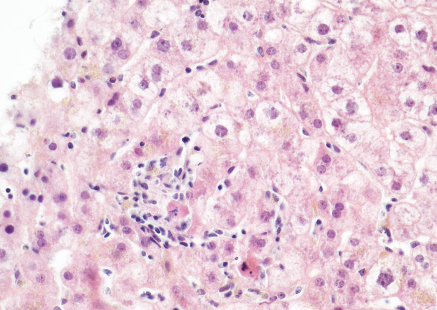 Lobular hepatitis in a heart-lung transplant patient in France. Apoptotic bodies, hepatocyte swelling and ballooning were present surrounded by a slight inflammatory infiltrate made of lymphocytes and histiocytes. Hematoxylin and eosin stain; original magnification ×40.