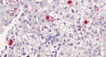 In situ hybridization in liver section from a heart-lung transplant patient in France. Chromogenic in situ hybridization detected human circovirus type 1 mRNA (red staining) in hepatocytes nuclei and cytoplasm. Nuclei were counterstained with Harris hematoxylin and eosin stain; original magnification ×40.