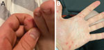Painful pustular lesions on left foot (A) and hand (B) of a 20-year-old man 1 day after onset of influenza-like symptoms, Germany. PCR results were positive for enterovirus but negative for orthopoxvirus, confirming hand, foot, and mouth disease rather than monkeypox.