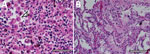 Postmortem autopsy findings in a fatal case of heartland virus disease acquired in the mid-Atlantic region, United States. A) Hematoxylin and eosin stain of patient accessory spleen; arrow indicates congestion with hemophagocytic histiocytes. Scale bar indicates 50 μm. B) Hematoxylin and eosin stain showing pulmonary hyperinflammation, including pleural thickening and adhesions, and pulmonary fibrosis, edema, and calcifications. Scale bar indicates 125 μm.