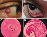 Trematode infection in the eyes of 2 pediatric patients in a study of ocular trematodiasis in children, Sri Lanka. A, B) Episcleral nodules found in eyes of 2 male pediatric patients. C, D) Metacercarial stage of a trematode in hematoxylin/eosin-stained tissue section of an excised episcleral nodule from a 12-year old boy. a, anterior end; p, posterior end; s, space between the larva and cyst wall; w, double layer cyst wall. Arrows in panel D indicate possible spines on surface tegument. Original magnification ×40 for panel C, ×100 for panel D.