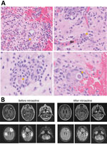Diagnostic findings for patient with granulomatous amebic encephalitis, California, USA. A) Brain biopsy sample. Granulomas are noted in a perivascular pattern. Scattered structures (arrows) with large nuclei and abundant cytoplasma are concerning for amebic trophozoite forms. Occasional structures with a large nucleus present within a relatively rigid outline (lower right image) are suspicious for amebic cysts, the dormant, thick-walled life stage. B) Magnetic resonance images obtained before and after nitroxoline treatment. Upper row shows axial gadolinium-enhanced T1-weighted images; lower row shows axial fluid-attenuated inversion recovery images. Images in the left series were obtained on day 96 after initial visit, 1 week before nitroxoline initiation; images in the right series were obtained on day 156 after initial visit, 7 weeks after nitroxoline initiation. BV, blood vessel.