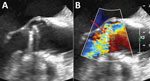 Trans-esophageal echocardiography without doppler (A) and with doppler (B) of the mechanical aortic heart valve in a woman diagnosed with Mycoplasma genitalium endocarditis. Red arrow indicates severe paraprosthetic regurgitation. 