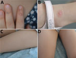 Figure. Monkeypox virus lesions for the 4-year old daughter in a family (father, mother, 2 children) infected with the virus, August 6, 2022. A) Umbilical pustule on pulp of the finger; B) papulopustule on the ankle; C, D) faint erythematous rash on the thighs.