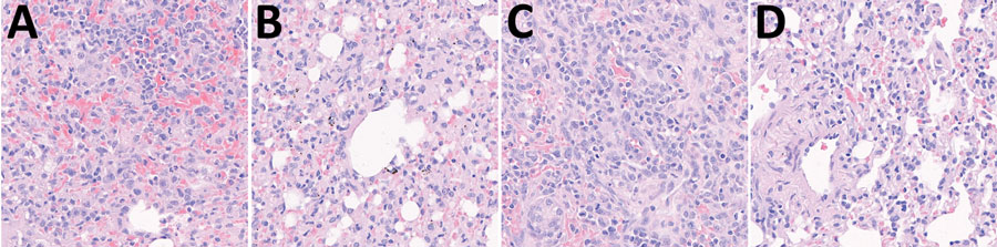 Pathologic changes in the lungs of dogs in study of experimental infection and transmission of SARS-CoV-2 Delta and Omicron variants among beagle dogs. A) Lung tissue from dog experimentally infected with Delta variant shows alveolar septa severely thickened by the infiltration of lymphocytes, macrophages, degenerate neutrophils, and karyorrhectic cellular debris. B) Lung tissue from naive (transmission) dog housed with Delta-infected dog shows alveolar septa thickened by the infiltration of numerous macrophages and lymphocytes, along with collagen accumulation. C) Lung tissue from dog experimentally infected with Omicron variant shows severe interstitial pneumonia and alveolar septal thickening due to the infiltration of lymphocytes, macrophages, and degenerate neutrophils. D) Lung tissue from naive (transmission) dog housed with Omicron-infected dog shows alveolar septa thickened by few macrophages, lymphocytes, and degenerate neutrophils. Original magnification ×400.