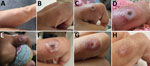Evolution of finger skin lesions in healthcare worker occupationally exposed to monkeypox virus, California, USA, 2022. A) August 29; B) August 31; C) September 4; D) September 5; E) September 6; F) September 7; G) September 24; H) September 28.