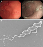Endoscopic images from a gastric ulcer patient infected with Helicobacter ailurogastricus and morphologic observation and genomic comparison of isolated H. ailurogastricus NHP21-4376 and NHP21-4377 strains, Japan. A) Multiple linear erosions and small ulcers on the background mucosa with no evidence of atrophy in the gastric antral area. B) Scanning electron micrograph of Helicobacter ailurogastricus strain NHP21-4377. Scale bar indicates 2 μm.