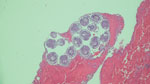 Lung biopsy specimen from a patient with Echinococcus granulosus tapeworm infection shows a daughter cyst containing multiple protoscolices with internal hooklets and calcareous corpuscles. Hematoxylin and eosin stain; original magnification ×100.