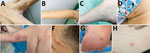 Monkeypox virus lesions from 2 female travelers returning to Vietnam from Dubai, United Arab Emirates, 2022. A–D) patient 1; E–H) patient 2. Images show lesions sporadically distributed on different body parts, including on patient 1 between 2 fingers (A), right arm (B), right foot (C), and face (D); and for patient 2, on a finger (E), the face (F), the arch of the right foot (G), and abdomen (H).