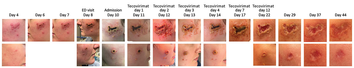 Progression of facial rash during mpox in a young woman in the absence of epidemiologic risk factors, Massachusetts, USA. Days since rash onset or beginning tecovirimat therapy are indicated. The rash began with pruritic erythematous macules on the bilateral infraorbital and malar areas, lower cutaneous lip, and chin and, by day 4, had progressed to vesicles followed by pustules on day 6 (top row, left cheek; bottom row, right cheek). On day 8 after rash onset, the patient had multiple confluent ulcers; macerated rolled borders were observed on the left cheek, and a single, large, deep-seated ulcer that had raised borders and a central hemorrhagic crust was observed on the right cheek. Satellite blisters and papules were present at early stages of ulcer development. The patient was started on tecovirimat on day 11 after rash onset, after which her lesions continued to evolve and had eventual loss of central eschar but persistent exudative, macerated borders by day 12 of tecovirimat therapy (day 22 after rash onset). Smaller lesions were treated with mupirocin ointment and dressed with loose gauze coverings. Toward the end of her 14-day treatment course (day 22), the escharotic ulcers developed granulated tissue. Ulcers had abundant granulated tissue and no central eschar and had begun to reepithelialize ≈2 weeks after completion of therapy (day 37).